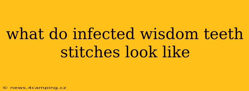 what do infected wisdom teeth stitches look like