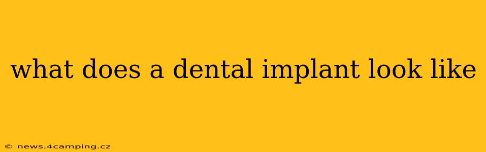 what does a dental implant look like