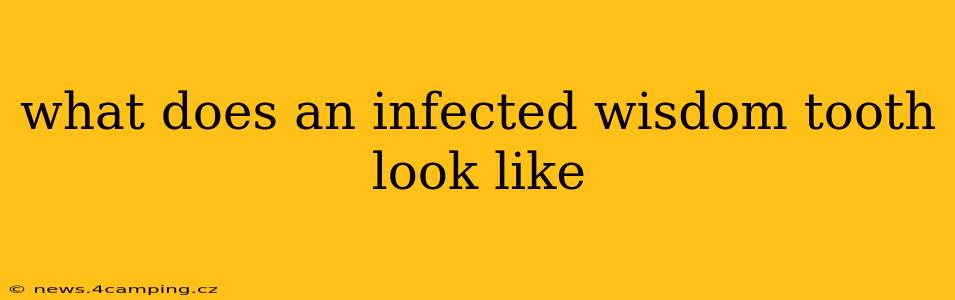what does an infected wisdom tooth look like