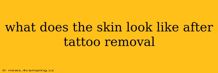 what does the skin look like after tattoo removal