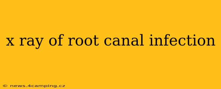 x ray of root canal infection